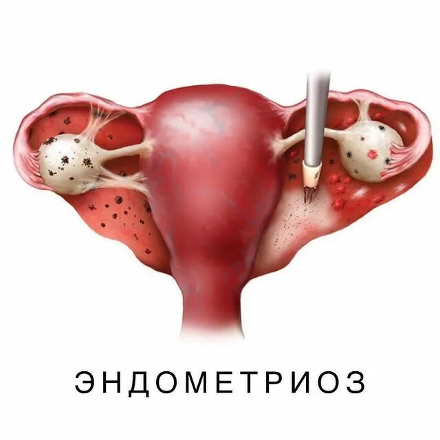 Как вылечить яичники у женщин