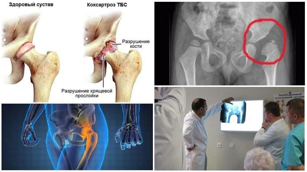 Артроз операция тазобедренного сустава. Коксартроз тазобедренного сустава 2 степени снимок. Коксартроз 2 степени тазобедренного сустава мрт. Коксартроз ТБС степени.