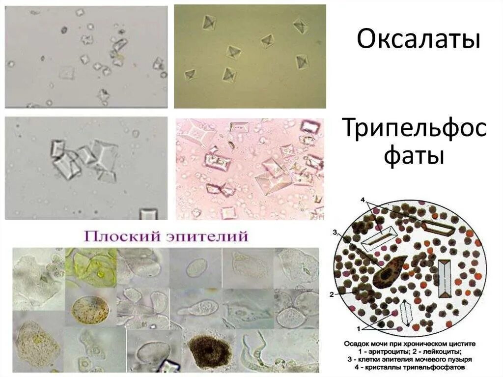 Фосфаты в моче у мужчин. Микроскопия осадка мочи трипельфосфаты. Оксалаты трипельфосфаты. Кристаллы оксалата кальция в моче. Оксалаты кальция микроскопия.