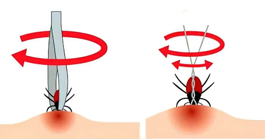 Как удалить клеща у человека самостоятельно. Как удалить клеща пинцетом. Как вытащить клеща пинцетом. Как достать клеща с помощью нитки. Как вытащить клеща самостоятельно в домашних условиях.