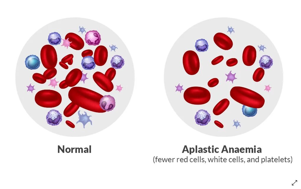 Анемия 2024. Анемия иллюстрация. Апластическая анемия Фанкони.