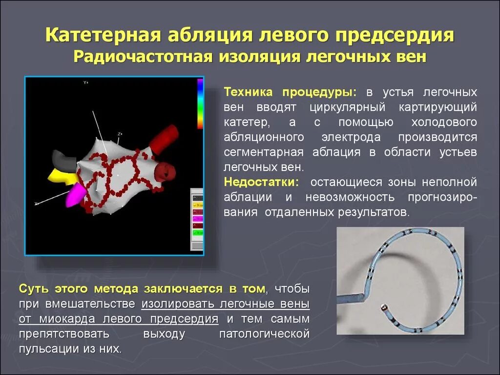 Радиочастотная абляция РЧА. Радиочастотная катетерная абляция сердца. Абляция фибрилляции предсердий. Радиочастотная изоляция легочных вен. Изоляция легочных вен