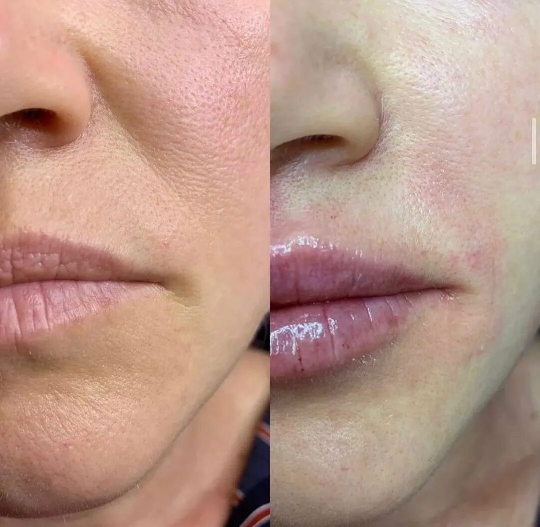 Носогубные складки. Залом на носогубной складке. Коррекция носогубных складок. Филлеры в носогубные складки. Рестилайн носогубные складки.