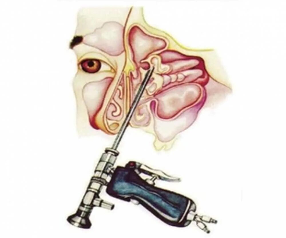 Пазух носа после прокола. Гайморит прокол гайморовой пазухи. Прокол (пункция) гайморовой пазухи. Пункция гайморовой пазухи операция. Гайморит прокол лобной пазухи.