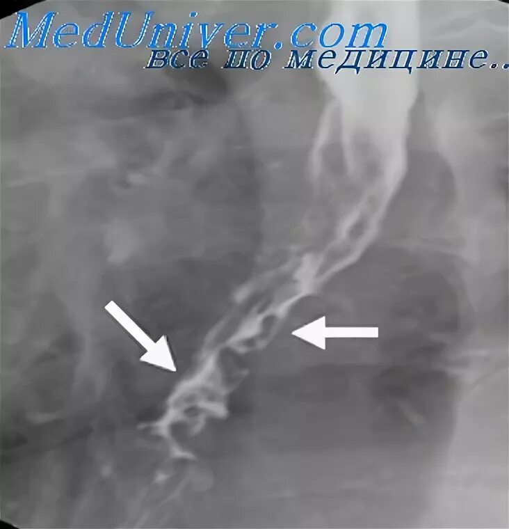 Варикозное расширение вен пищевода рентгенограмма. ВРВП -варикозное расширение вен пищевода. Варикозные вены пищевода. Варикозное расширение вен пищевода рентген.