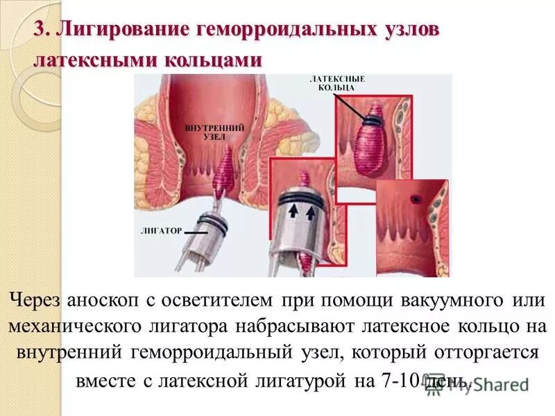 После лигирование геморроидальных узлов. Лигирование геморроя кольцами. Вакуумное лигирование латексными кольцами. Лигирование геморроидальных узлов, наложение 1 латексного кольца. Лигирование узлов геморроя это что такое.