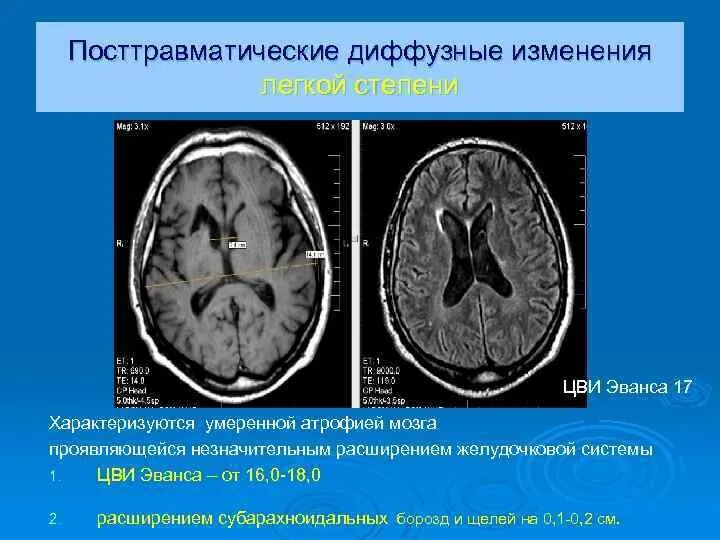 Субатрофические изменения мозга. Субатрофические изменения головного мозга. Субатрофии коры головного мозга. Субатрофия лобных долей. Умеренная субатрофия мозга что такое.