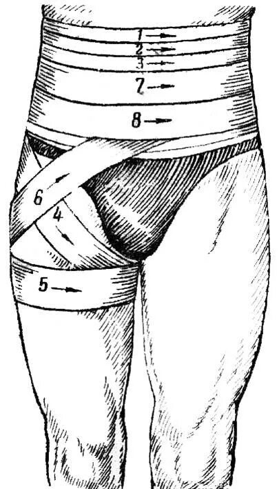 Бедренная перевязка. Колосовидная повязка на тазобедренный сустав. Техника наложения колосовидной повязки на тазобедренный сустав. Бинтовые повязки на живот циркулярная. Колосовидная повязка на нижнюю область живота.