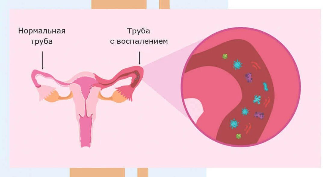 Какая матка при воспалении. Сальпингит, эндометрит, сальпингоофорит.. Сальпингит аднексит маточной трубы. Сальпингоофорит (аднексит).