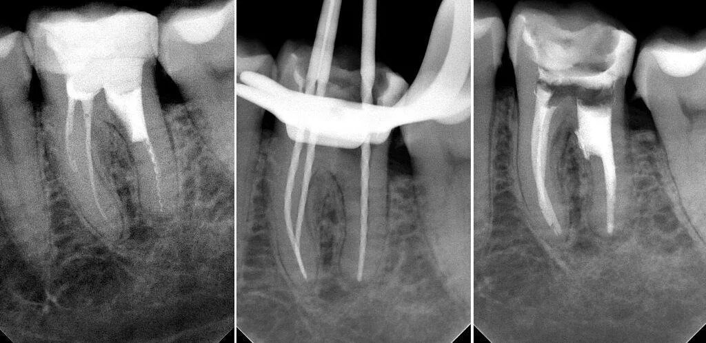 Восстановление после эндодонтического лечения. Обтурация корневого канала рентген. Гуттаперчевый штифт на рентгене. Периапикальный периодонтит кт. Запломбированные корневые каналы зуба.