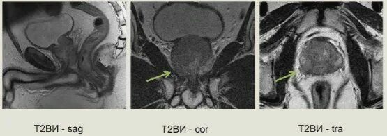 Карцинома мрт предстательной железы. Аденокарцинома предстательной железы мрт. Зоны предстательной железы мрт. Абсцесс предстательной железы кт. Аденома простаты мрт