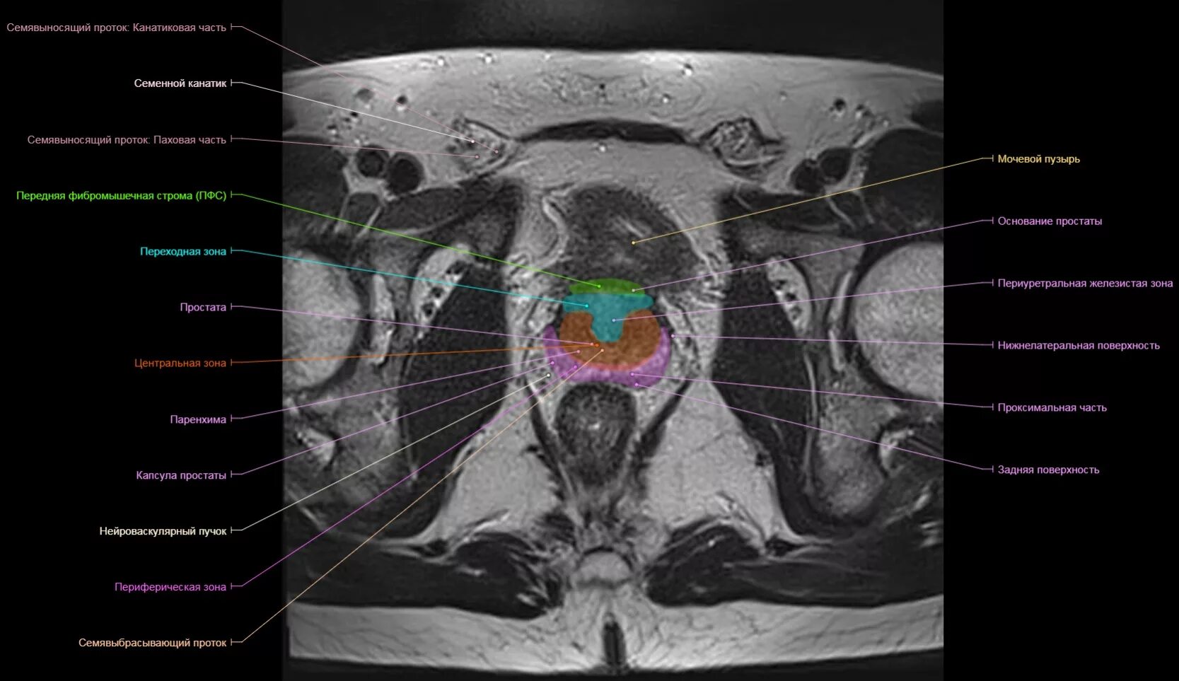 Предстательная железа капсула. Сегменты предстательной железы мрт. Анатомия предстательной железы мрт схема. Зональная анатомия предстательной железы мрт. Зональное строение предстательной железы мрт.