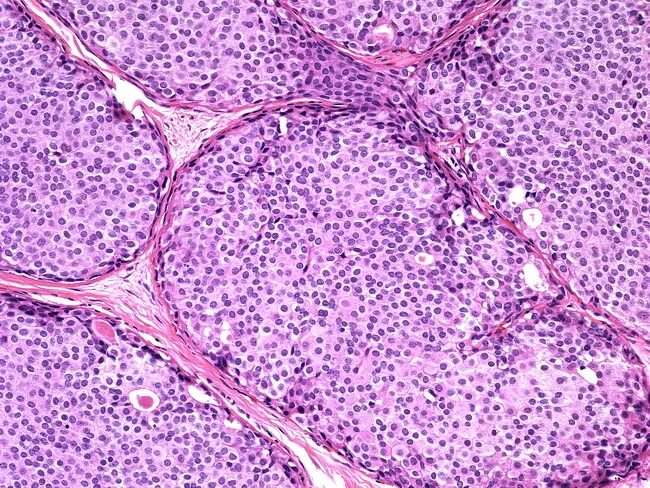 Гистология внутрипротоковой карциномы in situ. Карцинома «in situ» характеризуется. Плоскоклеточная карцинома in situ. Карцинома in situ эндометрия гистология. Карцинома сито.