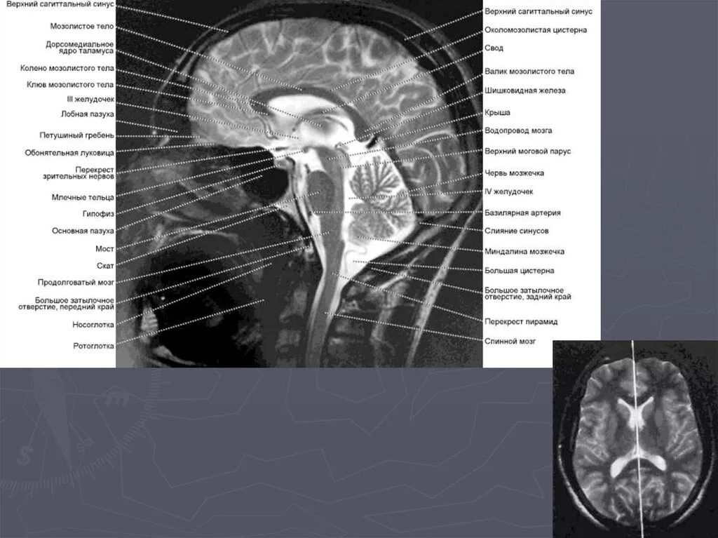 Цистерны мозга расширены. Анатомия промежуточного мозга мрт. Анатомия головного мозга мрт сагиттальные срезы. Мрт норма анатомия головного мозга. Кт анатомия головного мозга аксиальные срезы.