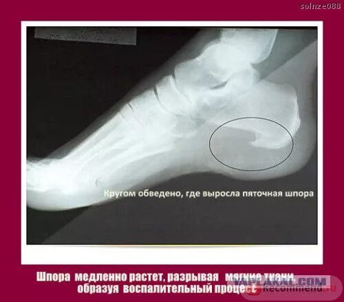 Пяточная шпора проходит сама по себе. Плантарный фасциит стопы рентген. как выглядит шпора на пятке на рентгеновском снимке.