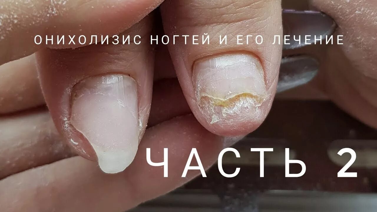 Против онихолизиса. Онихолизис ногтей онихолизис. Онихолизис капли для ногтей.