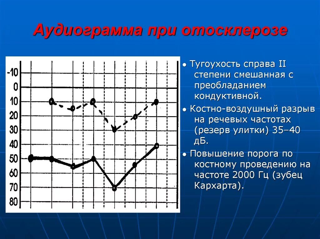 Аудиограмма при кондуктивной тугоухости 2 степени. Сенсоневральная тугоухость аудиограмма. Нейросенсорная тугоухость 4 степени аудиометрия. Отосклероз аудиограмма зубец Кархарта. Аудиограмма степени