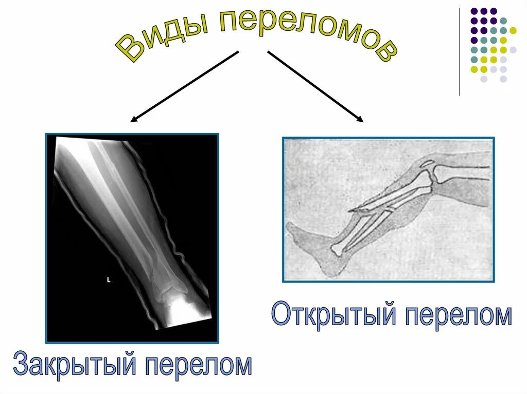 Открытая трещина. Открытый и закрытый перелом. Открытый перелом рисунок.