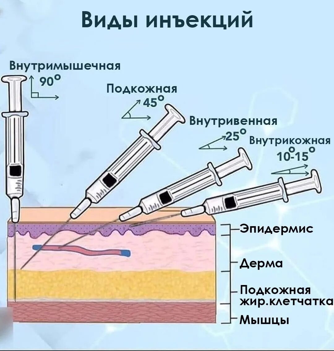 Виды инъекций. Углы введения иглы при инъекции. Внутрикожно и подкожно. Уколы вытекают почему