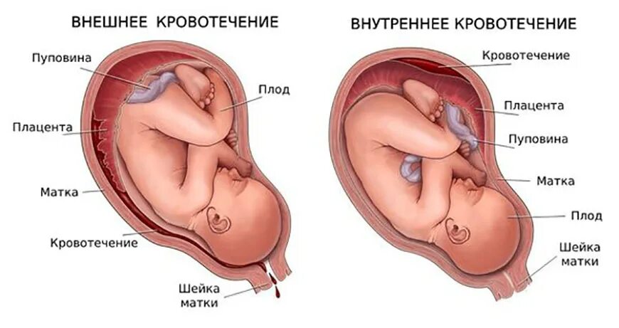 Отслойка плаценты гематома. Отслойка плаценты у беременных. Обширная отслойка плаценты.