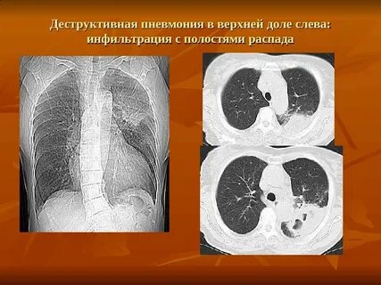 Деструктивных легких