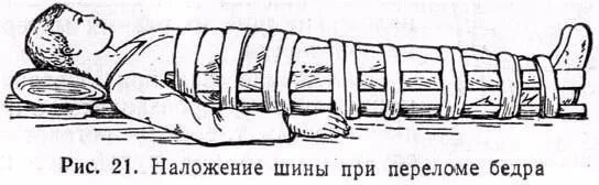 Наложение шины при переломе. Перелом шейки бедра наложение шины. шина при переломе бедренной кости. наложение шины при закрытом переломе бедренной кости. порядок наложения шины при переломе нижней трети бедра.