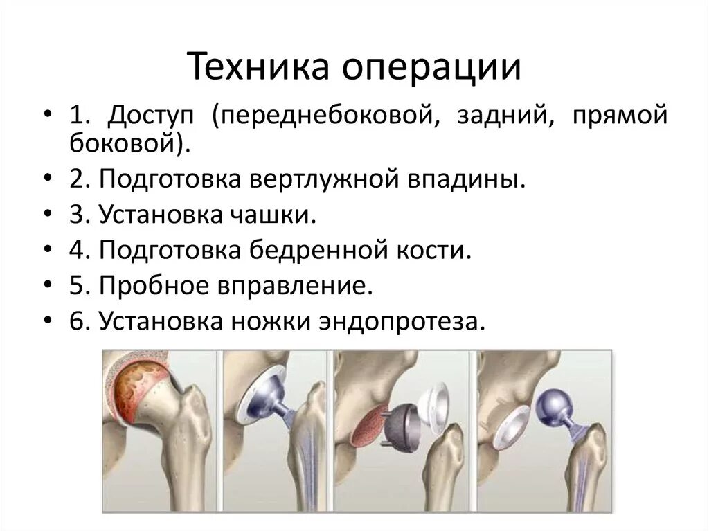 Перелом шейки бедра операция эндопротез. Эндопротезирование тазобедренного сустава техника операции. Тазобедренный сустав перелом шейки бедра. Эндопротез тазобедренного сустава этапы операции. Эндопротезирование тазобедренного отзывы пациентов