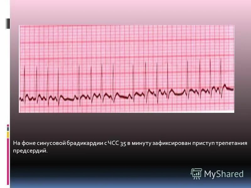 Слабость синусового узла мкб. Синусовый брадикардия с ЧСС 35. Синусовая аритмия с ЧСС 88-57. Брадикардия сердца у взрослых норма. Брадикардия сердца у подростка.