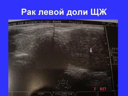 Кистозно солидное образование левой доли