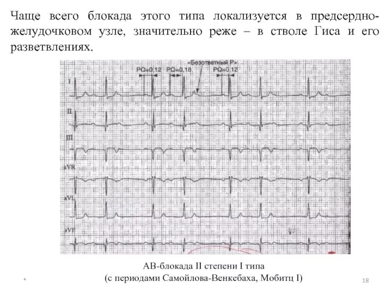 Ав блокада 2 мобитц 2 на экг. Синоатриальная блокада 2 степени мобитц 1. Период венкебаха на экг. Период венкебаха на экг. Атриовентрикулярная блокада мобиц 1 экг.