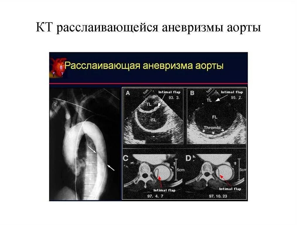 Аневризма нисходящего отдела аорты. Расслаивающая аневризма брюшной аорты кт. расслаивающая аневризма восходящего отдела. расслоение аневризмы аорты узи.