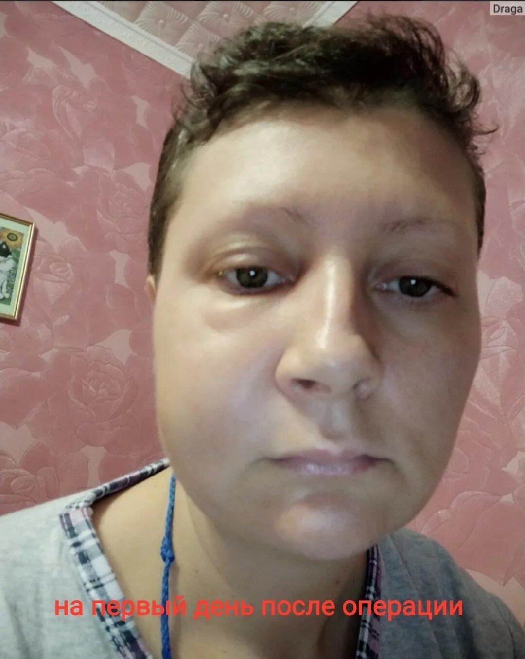 Отек после удаления зуба мудрости