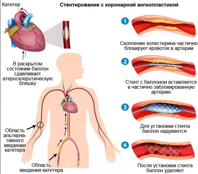 Стентирование коронарных артерий схема. Стентирование коронарных сосудов. Операция стентирование сосудов сердца. Операция при инфаркте стентирование. Стентирование сосудов последствия