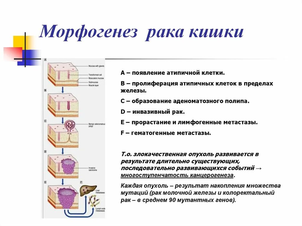 Опухоли кишечника патогенез. Новообразования прямой Кишк. Размеры опухоли кишечника по стадиям. Новообразования в прямой кишке. Онкология прямой кишки стадии