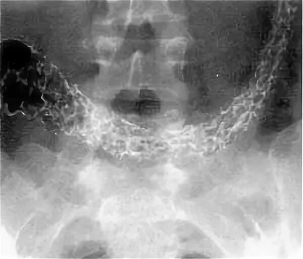 интерстициальная пневмония рентген. рентген легких рентген при хобл. плевральная спайка рентген. рентгенография крупозной пневмонии. интерстициальные заболевания легких рентген.