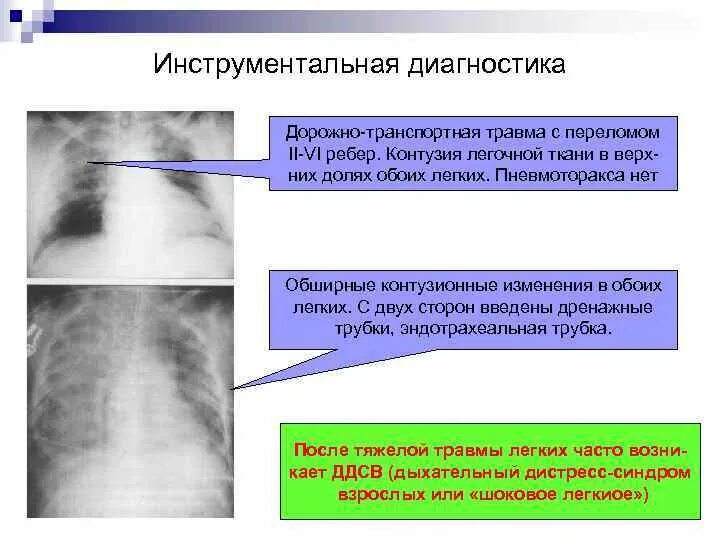 Контузия легочной ткани. Контузионные изменения. Контузионные изменения легкого. Контузионная травма легких. Контузионные изменения кости