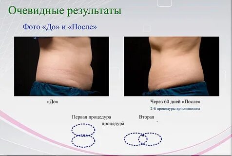 Криолиполиз что это такое отзывы