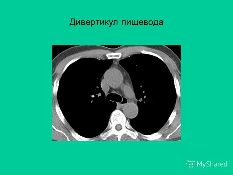 Кт при дивертикулах пищевода. Дивертикулы кишечника на кт. Дивертикул Ценкера пищевода кт.