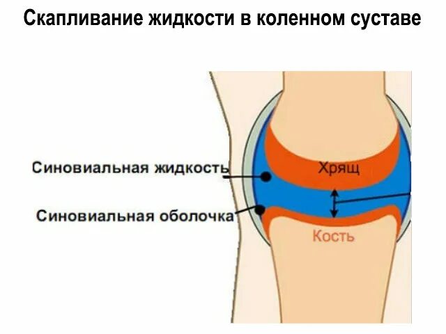 Жидкость в мениске. Жидкость в мениске. Синовиальная оболочка коленного сустава. Гемартроз тазобедренного сустава. Жидкость в мениске.