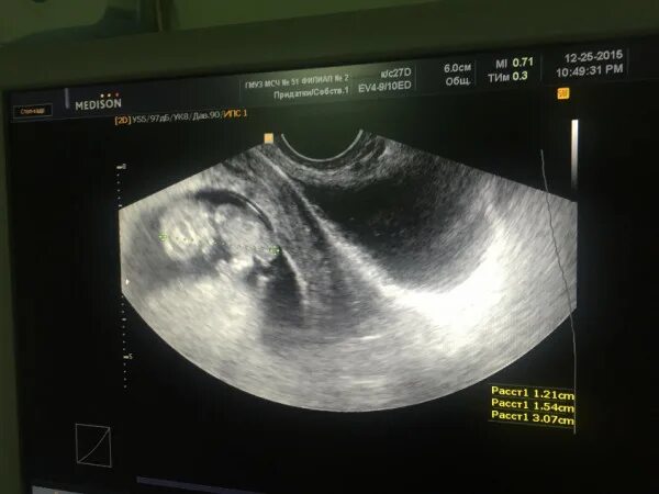 Ультразвуковое исследование скрининг беременности 12 недель. Снимок УЗИ 11 недель беременности. УЗИ 10 недель беременности. 11 И 5 недель беременности УЗИ. 12 недель и 6 дней