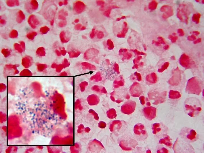Staphylococcus в мазке у женщин. Ангинозный стрептококк. стрептококк констеллатус. стрептококк ангинозус в мазке.