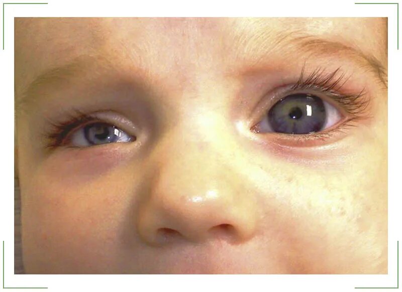 Детская глазная болезнь. Микрофтальм анофтальм. Микрофтальмия у новорожденных. Микрофтальмия патология. Врожденная патология микрофтальм.