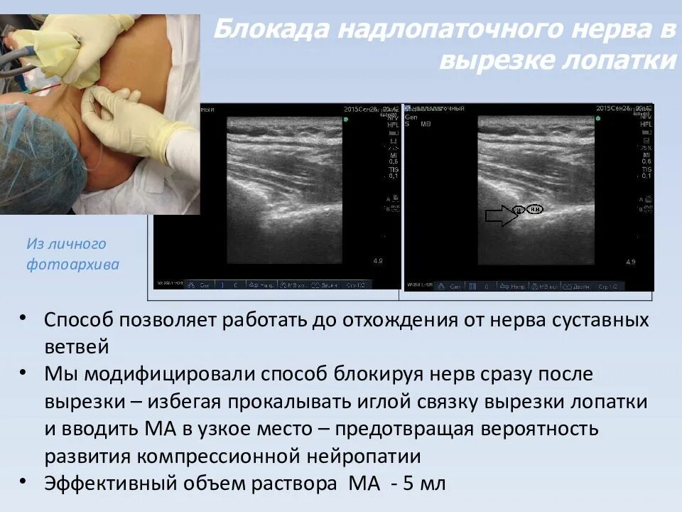 Нервная блокада. Блокада надлопаточного нерва. Синдром вырезки лопатки. Техника блокады надлопаточного нерва. Сдавление надлопаточного нерва.