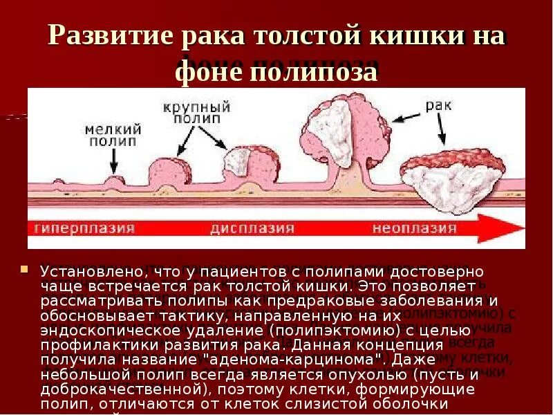 Как выглядит колоректальный рак Рак сигмовидной кишки с метастазами Запись на приём к онкологу Московский цент
