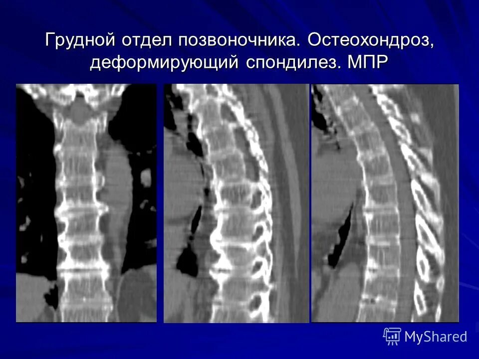 Спондилоартроз кт. Деформирующий спондилоартроз на кт. деформирующий спондилез грудного отдела позвоночника рентген. деф спондилез поясничного отдела позвоночника. спондилёз поясничного отдела позвоночника на кт.