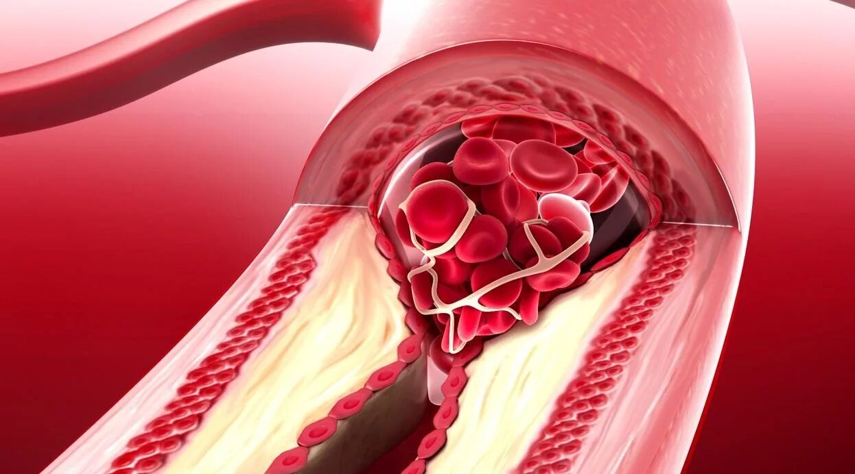 Как проверить сосуды на тромбы и холестериновые