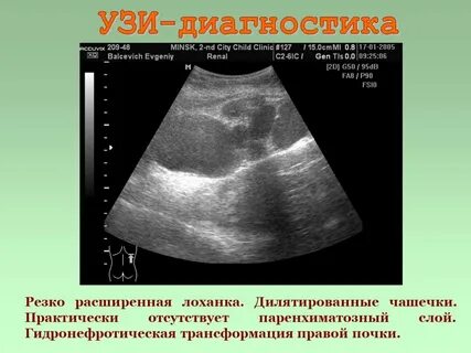 Лоханка почки на узи