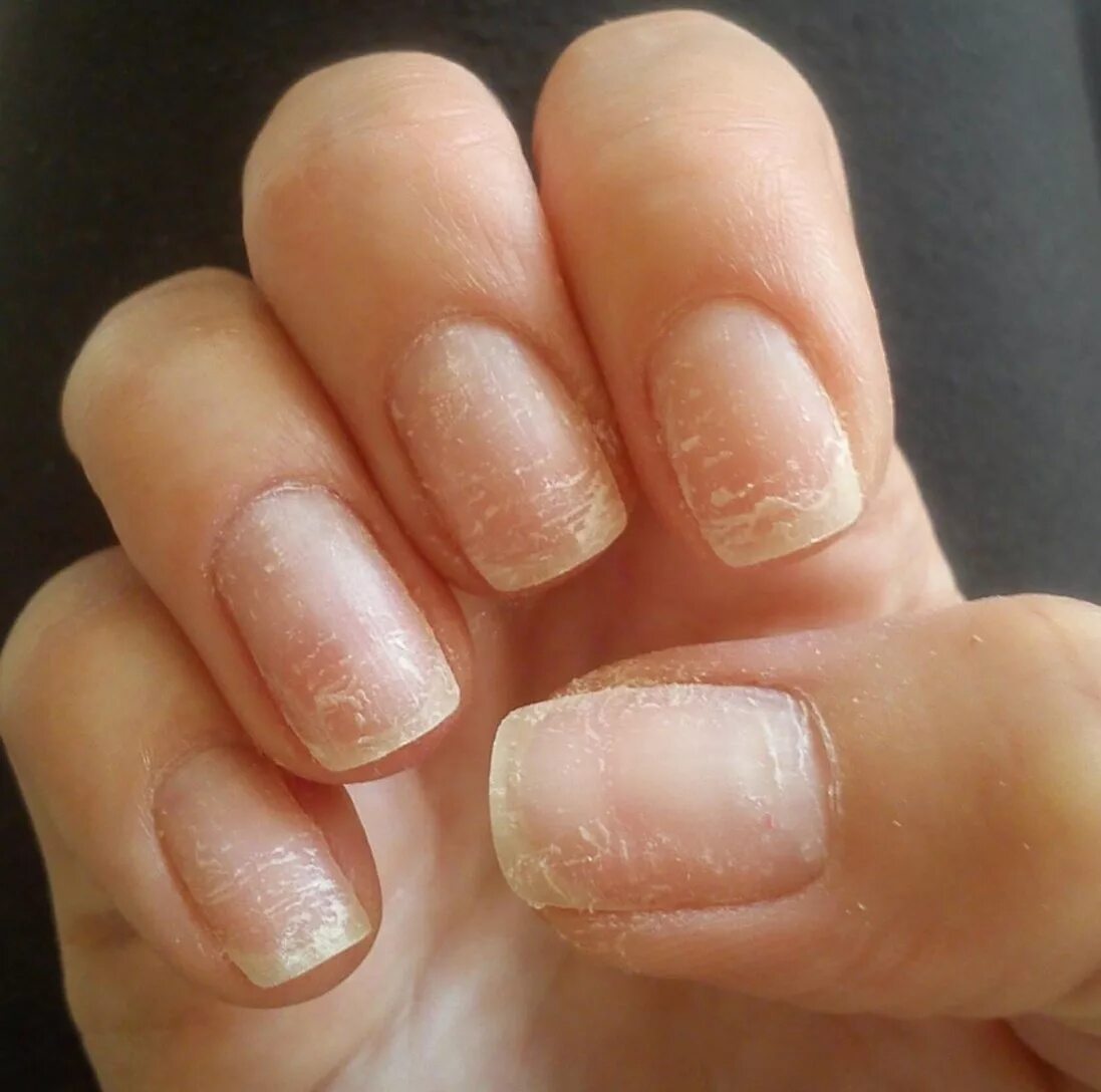 гиперкератотический онихолизис. онихолизис ногтевой пластины. дефект ногтей после гель лака. грибок ногтей после гель лака чем лечить. грибок ногтей после гель лака чем лечить.