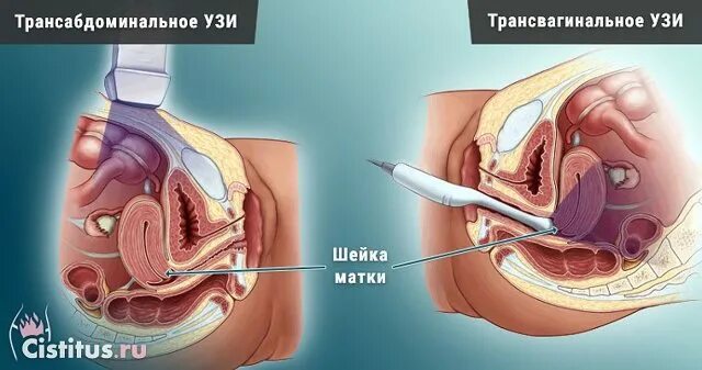Трансабдоминальное узи. Амниоцентез трансабдоминальный и трансвагинальный. трансабдоминальное ультразвуковое исследование. трансабдоминальным датчиком узи. трансабдоминальное узи шейки матки.