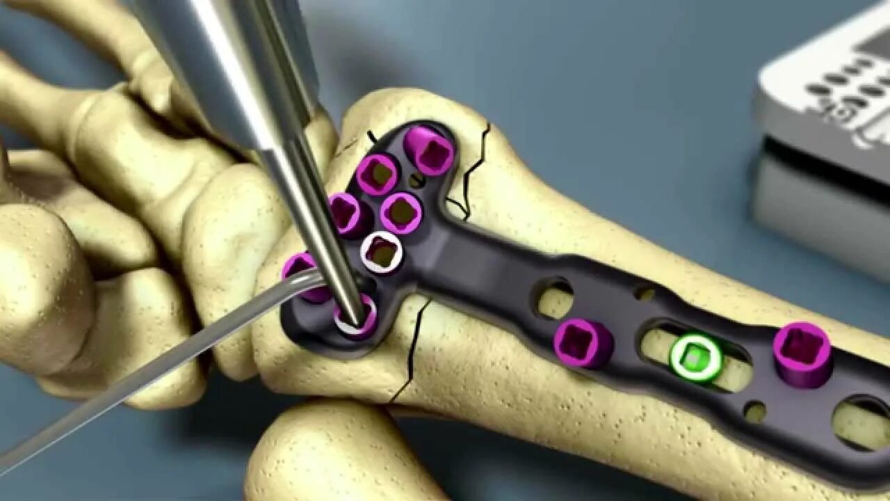 Остеосинтез операция пластины. Остеосинтез лучезапястного сустава. Пластина DVR лучевая дистальная. Остеосинтез лучевой кости. Остеосинтез лучевой кости пластиной.